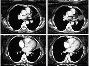 女58岁,因畏寒、发热5天,胸闷、气促4天入院