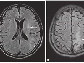 男41岁,因右侧肢体活动不灵、反应迟钝20余天,加重5天入院