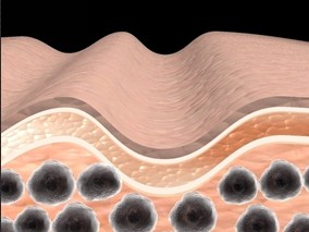黑色素瘤患者较低的维生素D水平与较差结局相关
