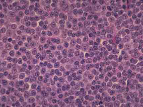 甲氨蝶呤、替莫唑胺和利妥昔单抗治疗原发性CNS淋巴瘤安全