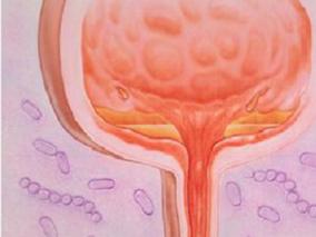 女58岁，因尿频伴憋尿痛5年余，进行性加重1年入院