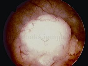 男70岁，因体检B超发现左肾积水10天入院
