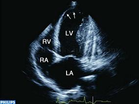 男56岁,24小时前无诱因突发胸闷,局限于胸骨下端,伴冷汗