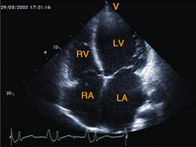 男44岁,心悸、乏力、胸部不适1年余,进行性加重,近期活动气短