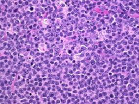 利妥昔单抗增加至短期强化化疗可改善成人伯基特淋巴瘤患者EFS