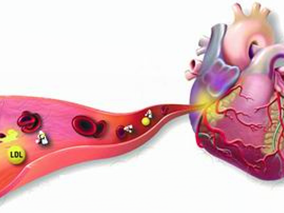 多学科讨论：稳定型缺血性心脏病他汀降脂有无必要降到70 mg/dL或以下
