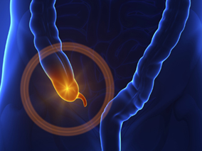 发现阑尾炎新的发病原因