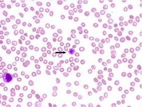 硼替佐米治疗严重难治性血栓性血小板减少性紫癜患者似乎有效