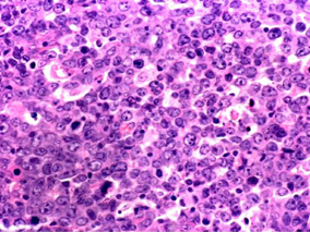 Coltuximabravtansine联合利妥昔单抗用于DLBCL患者的效果