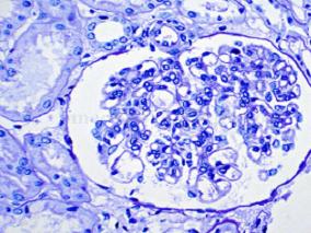 女11岁，因颜面、双下肢水肿伴腰部胀痛4天入院