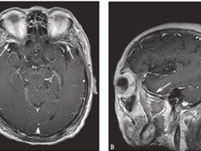 男性61岁,因双眼视物模糊半年,加重2周入院