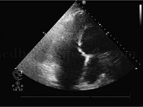 男68岁,喘憋反复发作13年,加重20天,夜间不能平卧2天
