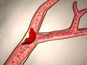 多学科讨论：急性缺血性卒中患者阿替普酶低剂量与标准剂量之争