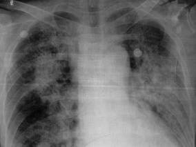 男75岁,急性阑尾炎术后第二天,突发呼吸困难2小时