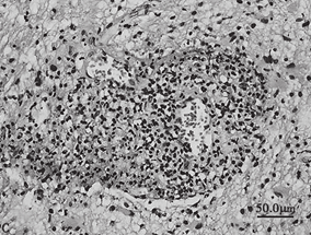 女32岁,因左侧肢体麻木5个月,右侧肢体无力12天入院