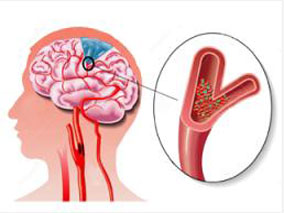 直接口服抗凝药能减少肾衰患者的出血性脑卒中风险