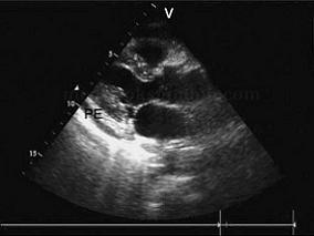 女44岁,反复咳嗽、低热5年余,呼吸困难、腹胀、下肢水肿10天