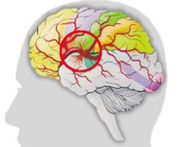 抗小板治疗相关脑出血后：标准治疗vs联合血小板输注