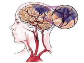 多学科讨论：TIA后是否需即刻服用阿司匹林？