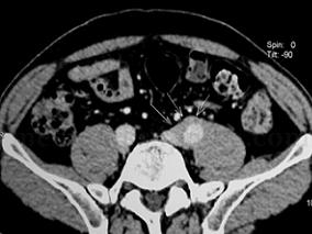 男54岁，因左下腹痛1个月入院
