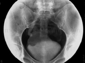 女32岁，经期尿痛1年，血尿伴右肾积水5个月