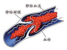 上肢深静脉血栓患者队列的特征