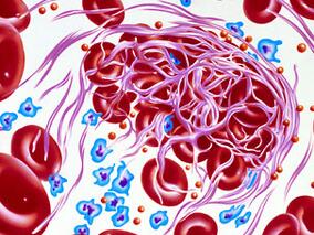多学科讨论：ABC风险评分能更好地预测房颤出血