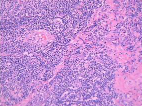 R-BL方案用于不适合蒽环类或强化挽救方案的侵袭性B细胞淋巴瘤患者