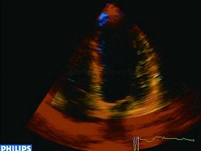 女63岁,8小时前无诱因出现胸闷、心悸、胸痛,为压痛,伴后背痛