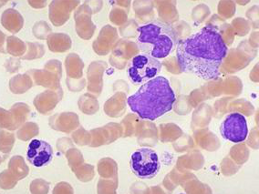 ELN建议对一线治疗慢性粒细胞白血病患管理的影响