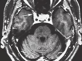 男68岁,因右眼疼痛伴右睑下垂1周入院