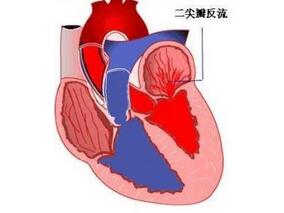 口服β受体阻滞剂在慢性风湿性二尖瓣返流中的作用
