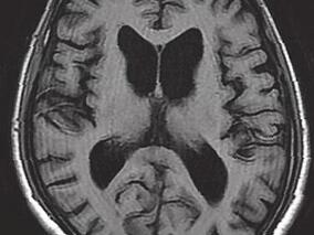 男52岁,进行性全身不自主运动伴记忆力减退10年余门诊就诊
