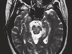女20岁,智能减退、左侧肢体僵硬20个月、左上肢震颤及抽搐发作10个月,右侧肢体僵硬和震颤4个月