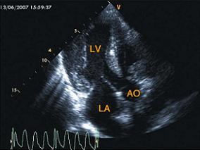 男56岁,6个月前无明显诱因出现乏力,活动后气短,腹泻,消瘦