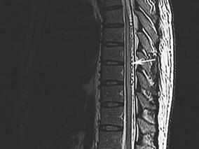 男34岁,双下肢麻木无力、跛行半年,二便困难3个月入院