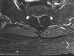 女55岁,臀部及双下肢麻木、烧灼感伴肌肉萎缩6年门诊就诊