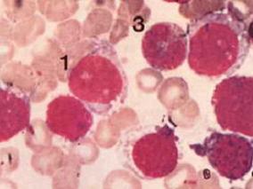 接受TKI治疗的CML患者血管事件风险或增加