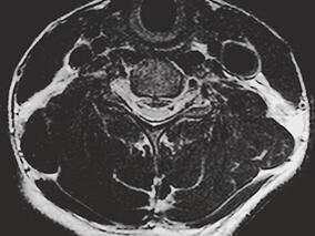 男20岁,右手中指、无名指背伸不能1年余门诊就诊