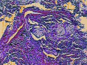 男67岁,咳嗽、咳痰、气促40余天,间断发热20余天