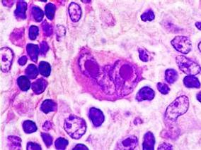 经典型霍奇金淋巴瘤：纳武单抗是未满足需求患者群体新的治疗选择