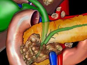 胰腺癌患者：诊断前循环代谢产物能否预测生存期？