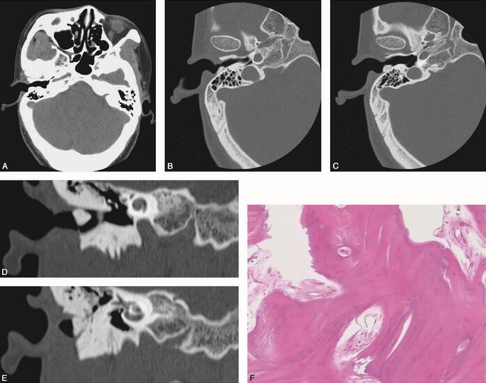 女39岁,发现右耳道渐进性狭窄8个月