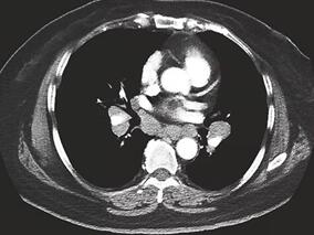 女63岁,腹部、背部麻木、疼痛2周,双上肢麻木、无力10天入院