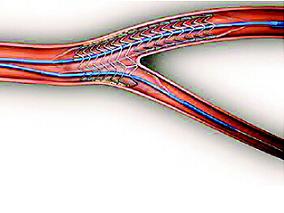 多学科讨论：行PCI的亚洲人群使用高强度阿托伐他汀效果更佳？