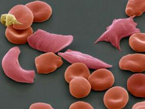 镰状细胞病：安全使用可待因的遗传药理学