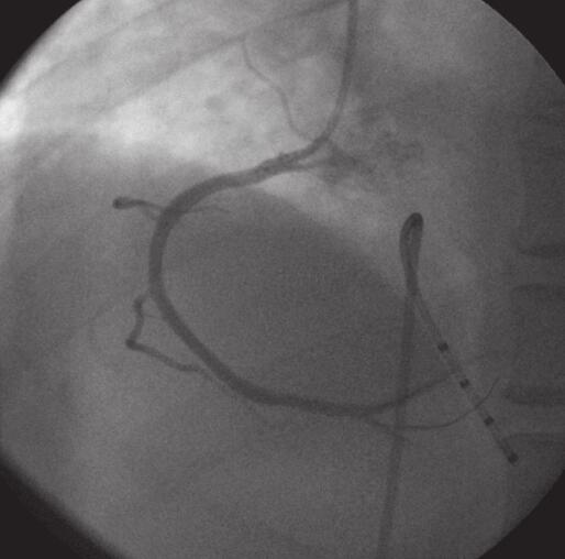 男51岁,发作性胸闷1天
