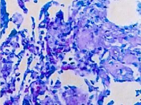 女61岁,反复发作性喘息56年,咳嗽、咳痰20余年,加重6天