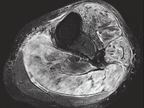 女40岁,左下肢肿痛1年,加重伴双肘、腕肿痛1个月入院