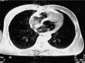 男32岁,心悸、胸闷4年,加重3个月,伴晕厥3次